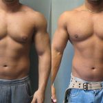 gynecomastia