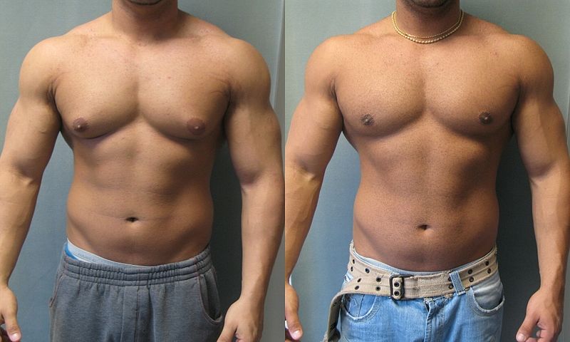 gynecomastia